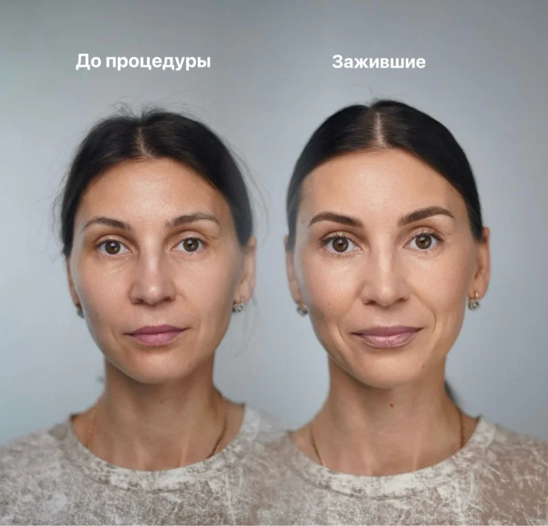 Заживший результат — работа Татьяны Бах
